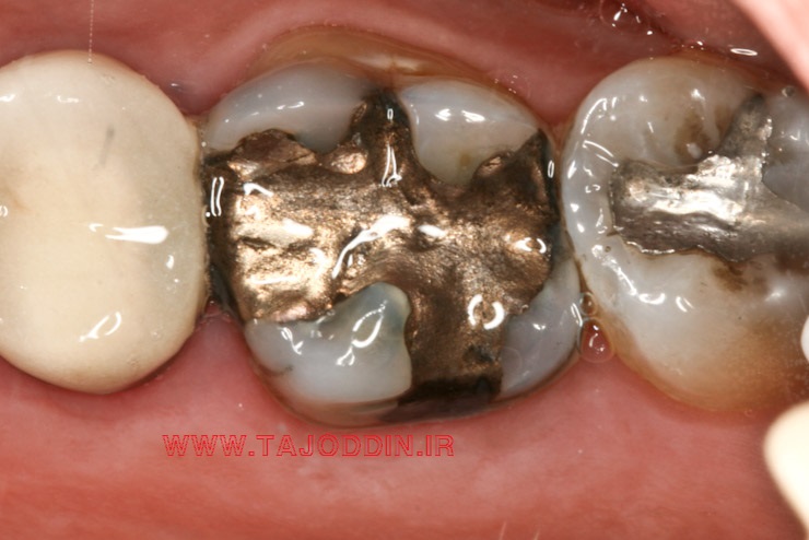 دستگاه پر کردن دندان