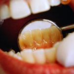 آینه دندانپزشکی استاندارد